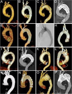 Outcomes of thoracic endovascular aortic repair with chimney technique for aortic arch diseases